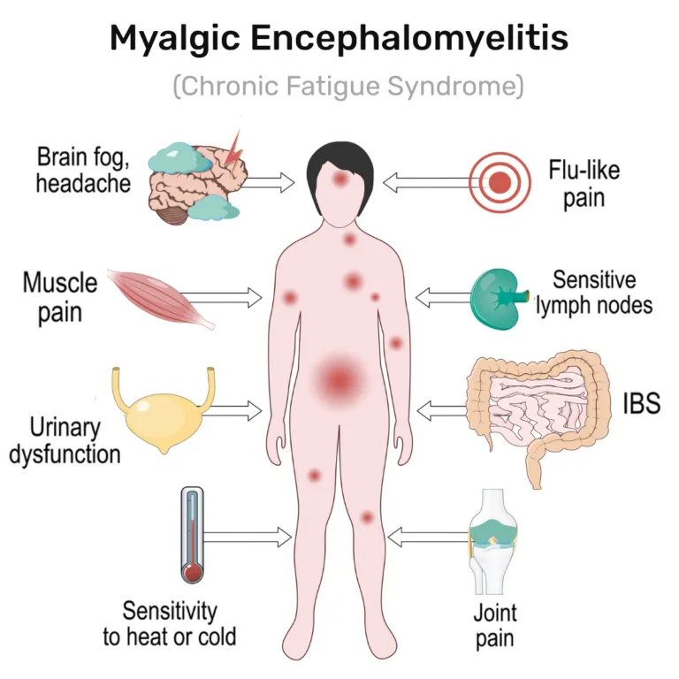 Myalgic Encephalomyelitis Chronic Fatigue Syndrome